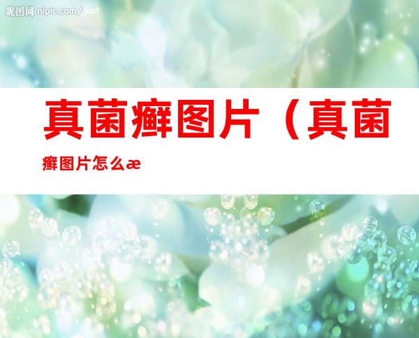 真菌癣图片（真菌癣图片怎么治）