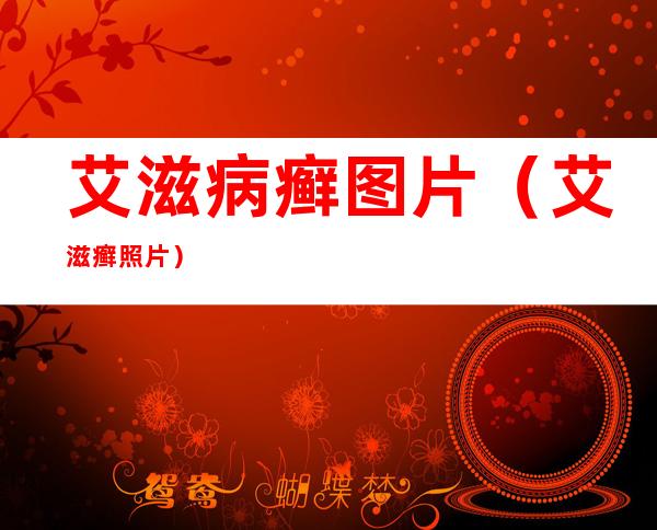 艾滋病癣图片(艾滋癣照片)
